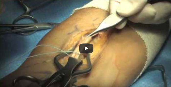 Biceps Tendon Repair by Dr Leo Rozmaryn