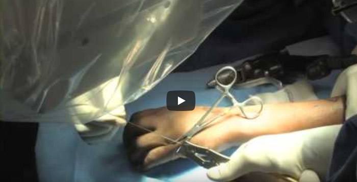 Closed Pinning of Finger Fracture by Dr Leo Rozmaryn Orthopedic Hand Surgeon